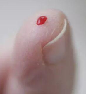 婴儿水银中毒需注意什么(春运进行时宝宝意外受伤)