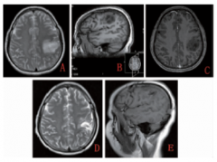 功能区胶质瘤术中直接皮层电刺激诱发癫痫发作