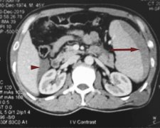 患者因左侧季肋部急性疼痛就诊，究竟是何因？