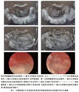 中期妊娠引产清宫后胚物残留致“动静脉瘘”两例探讨