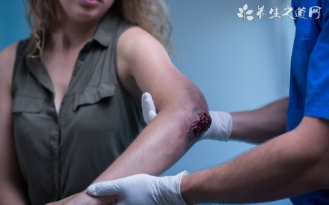 肌腱炎和腱鞘炎的区别有哪些