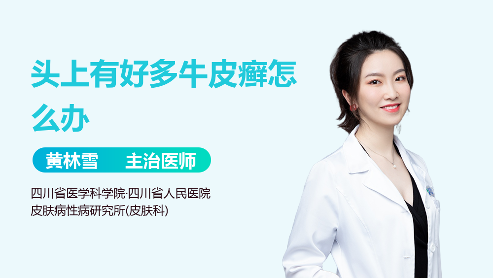 头上有好多牛皮癣怎么办