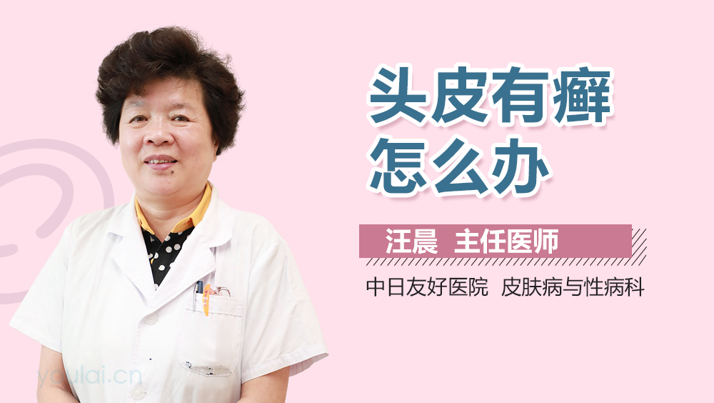 头皮有癣怎么办