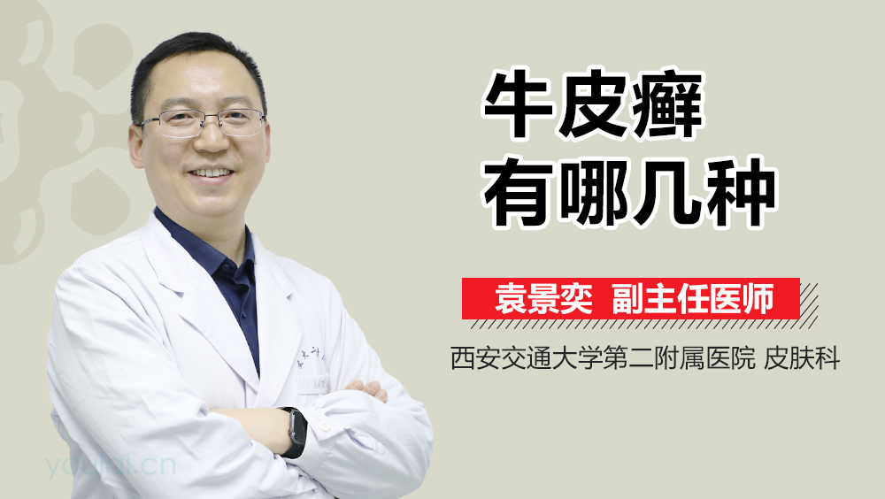 牛皮癣有哪几种