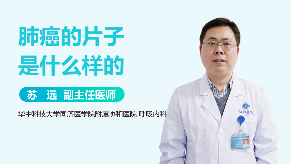 肺癌的片子是什么样的