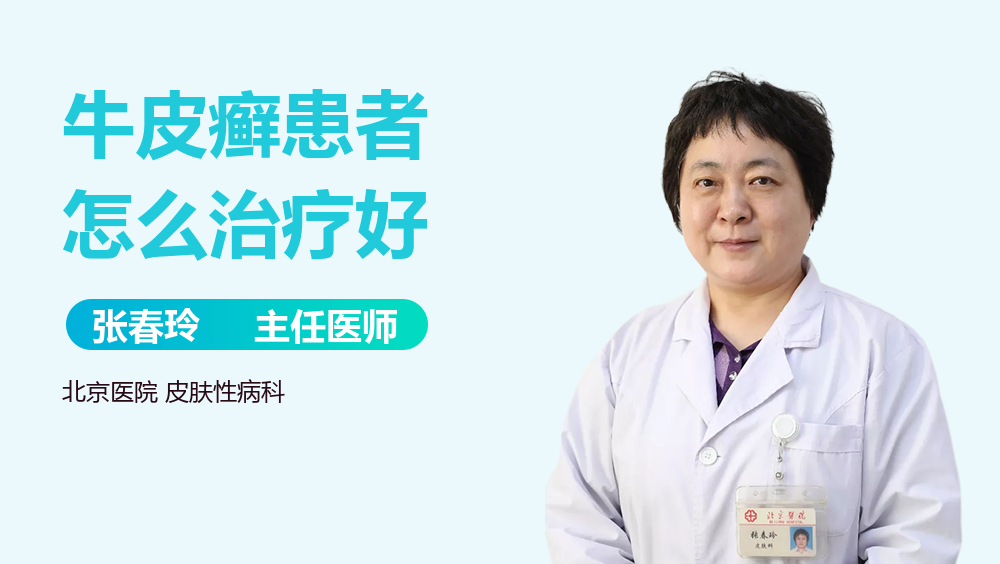 牛皮癣患者怎么治疗好
