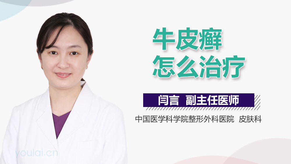 牛皮癣怎么治疗