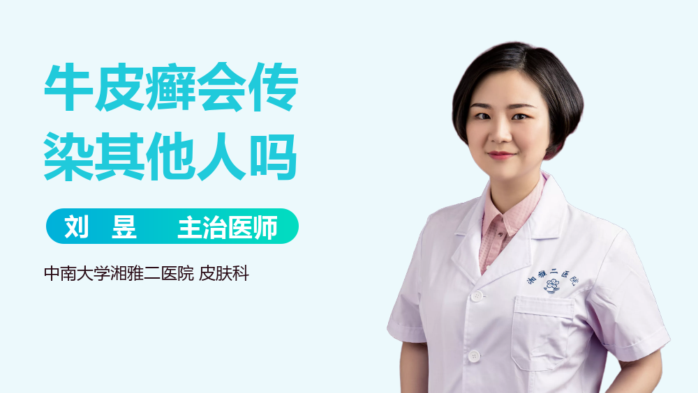 牛皮癣会传染其他人吗