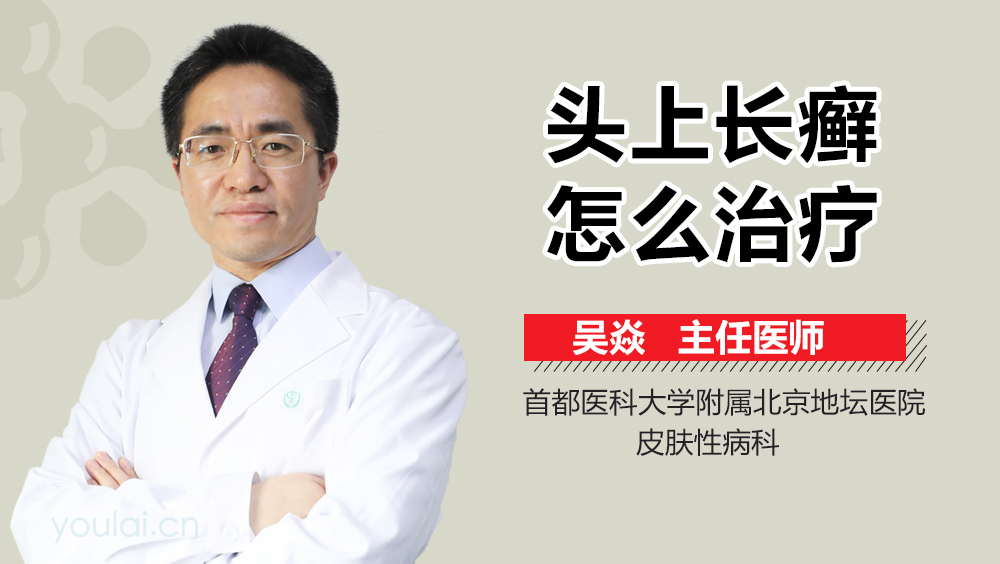 头上长癣怎么治疗