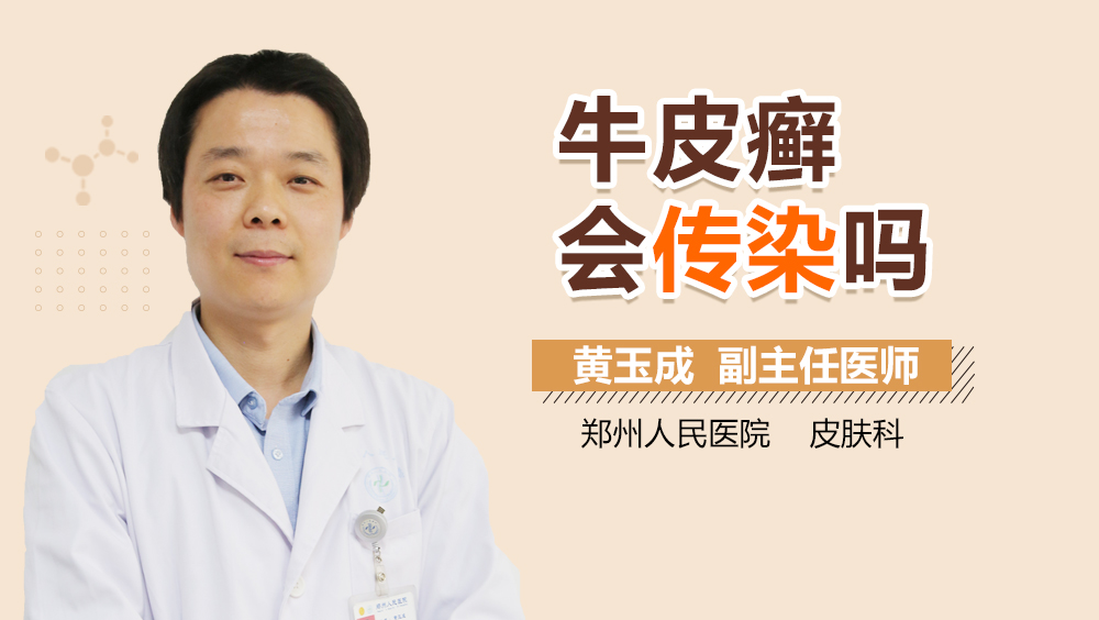 牛皮癣会传染吗