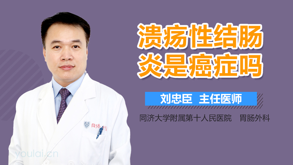 溃疡性结肠炎是癌症吗