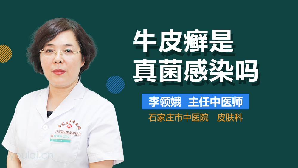 牛皮癣是真菌感染吗