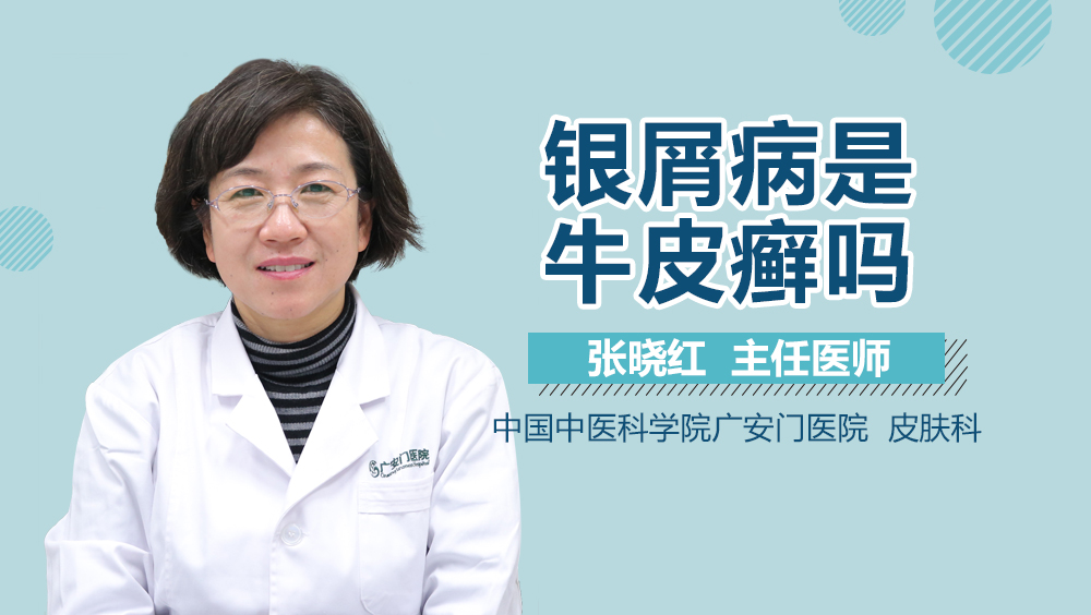 银屑病是牛皮癣吗