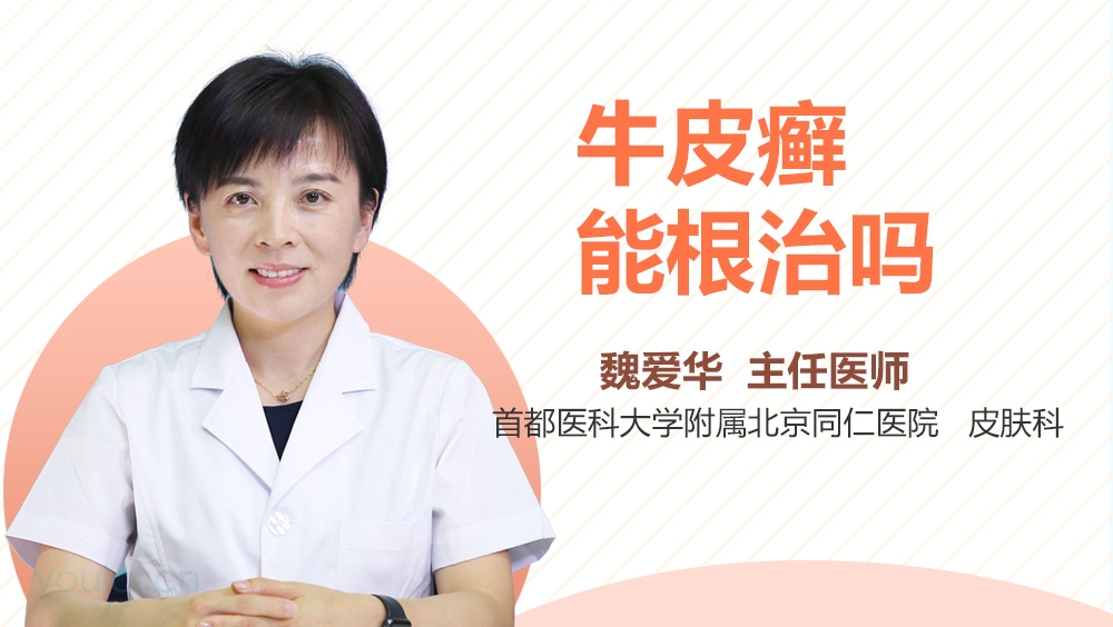 牛皮癣能根治吗
